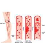 ⁦مشد ضاغط  بالحرارة للركبة و الساق⁩ - الصورة ⁦2⁩